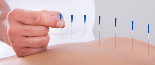 acupuncture treatment hand placing needle on skin back with multiple needles visible six acupuncture techniques used for wellness